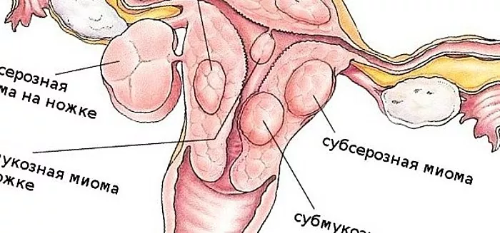kaalulangus parast emaka fibroid emboliseerimist parim viis rasvade kaotuse edendamiseks