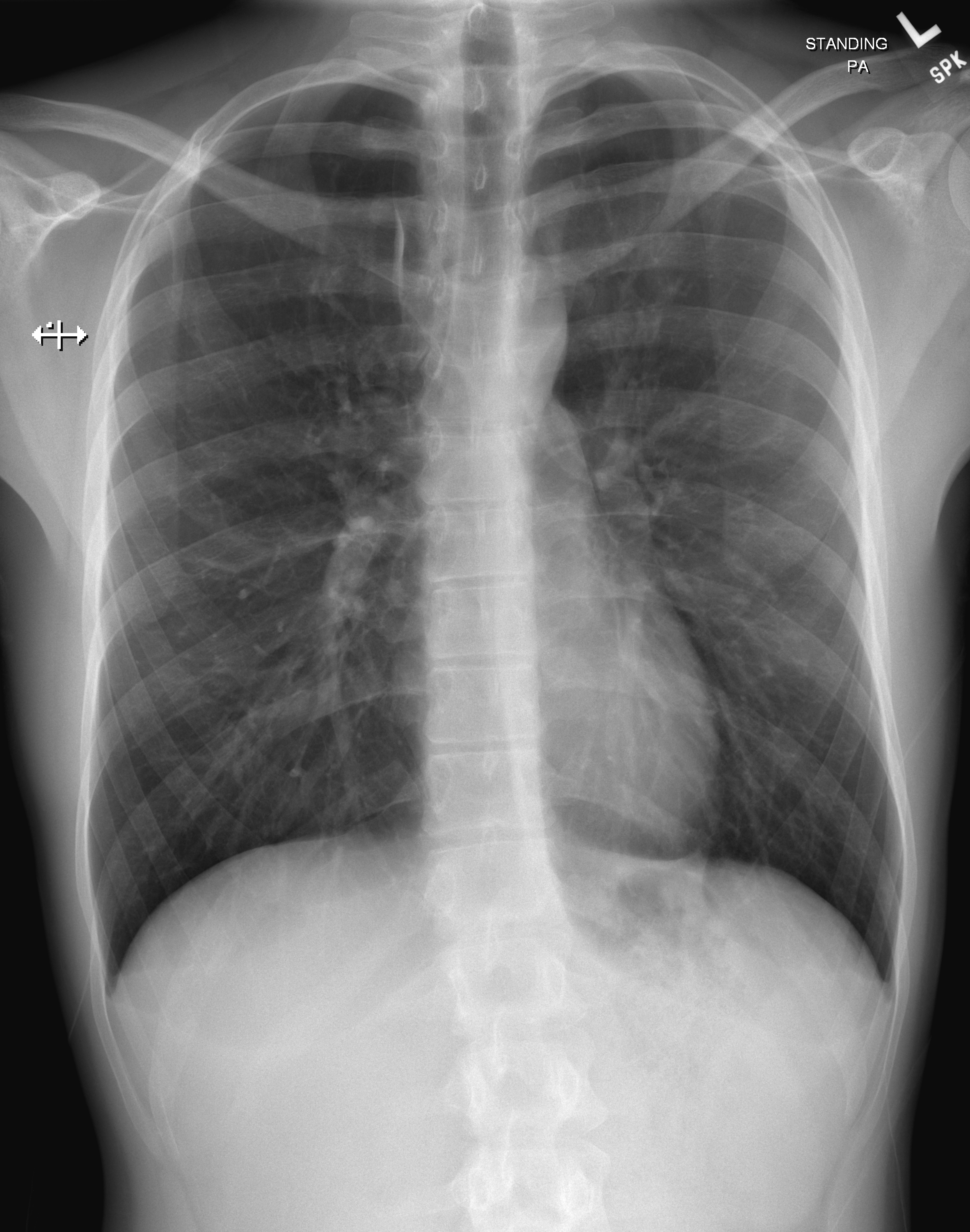 kaalulangus rindkere x ray
