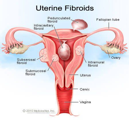 kaalulangus parast emaka fibroidi kuidas saada motivatsiooni kaal