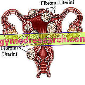 kaalulangus parast emaka fibroidi kaalulangus peatus keto